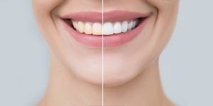 Before and after of teeth whitening